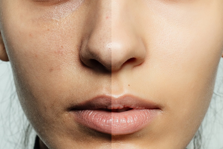 Fight Skin Pigmentation Problems with Skin Rejuvenation Treatments!