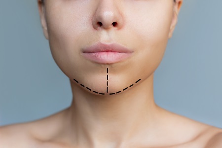 Jawline and Chin Contouring in San Jose