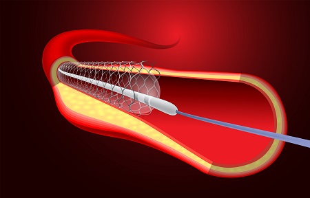Best Cardiologist in Pondicherry - How is Angioplasty and Stent Placement Done