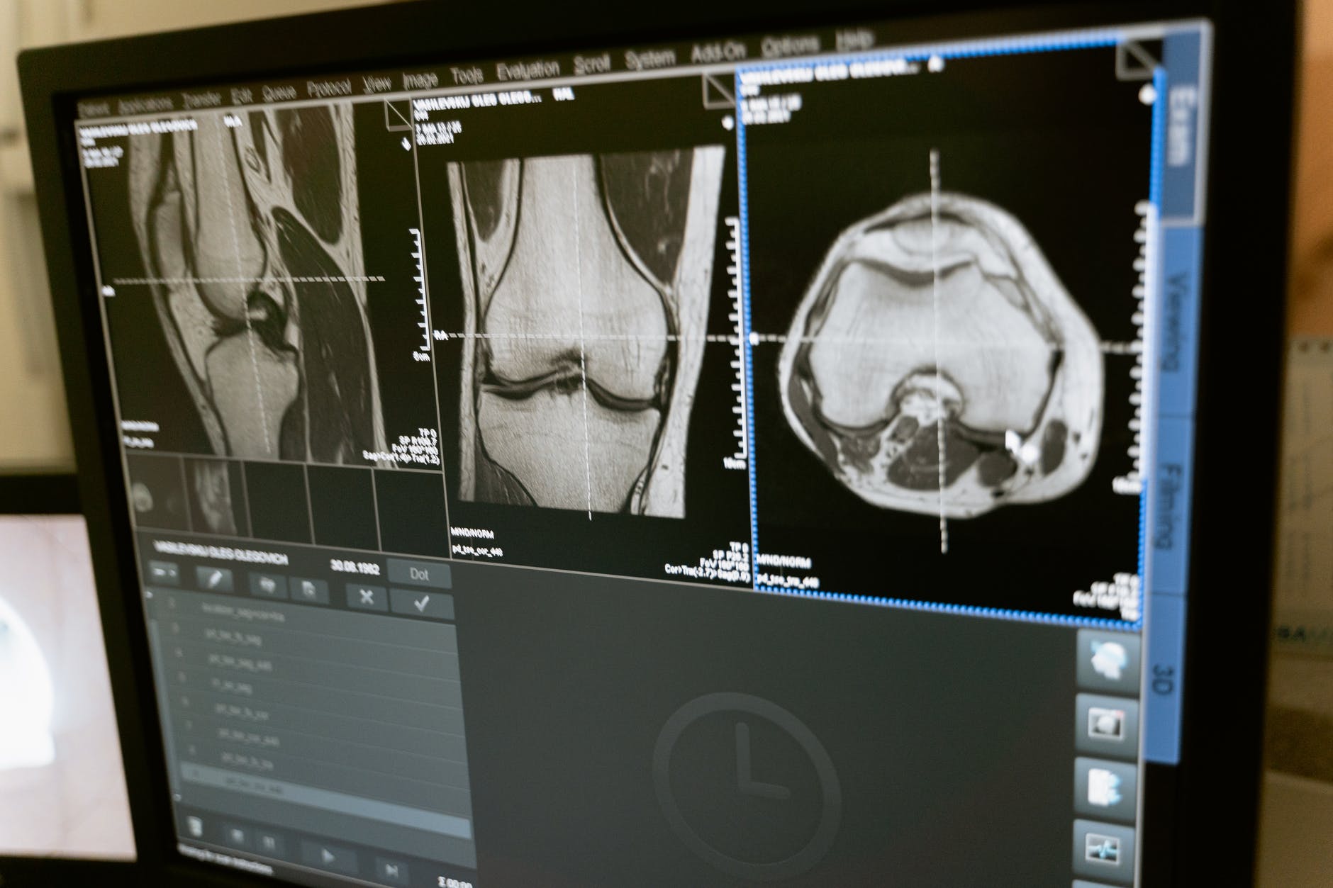 What is a Bone Density Test ?