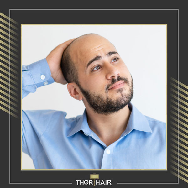 A Brief History Of Hair Transplantation