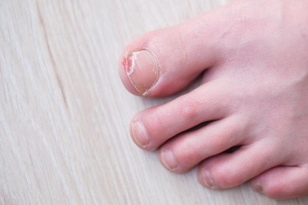 Managing Ingrown Toenails