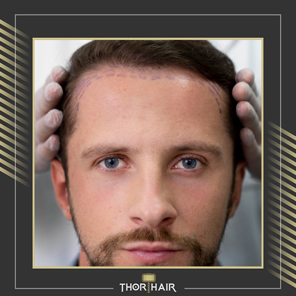 Hair Transplants – Are They Worth It?