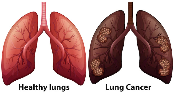 Lung cancer 