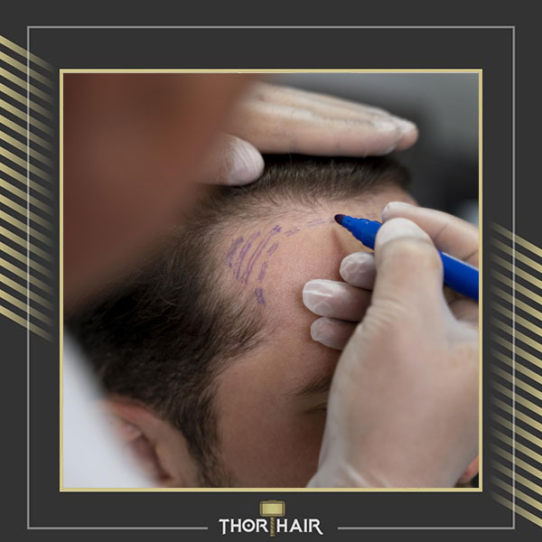 Why Turkey Is the Global Hair Transplant Destination