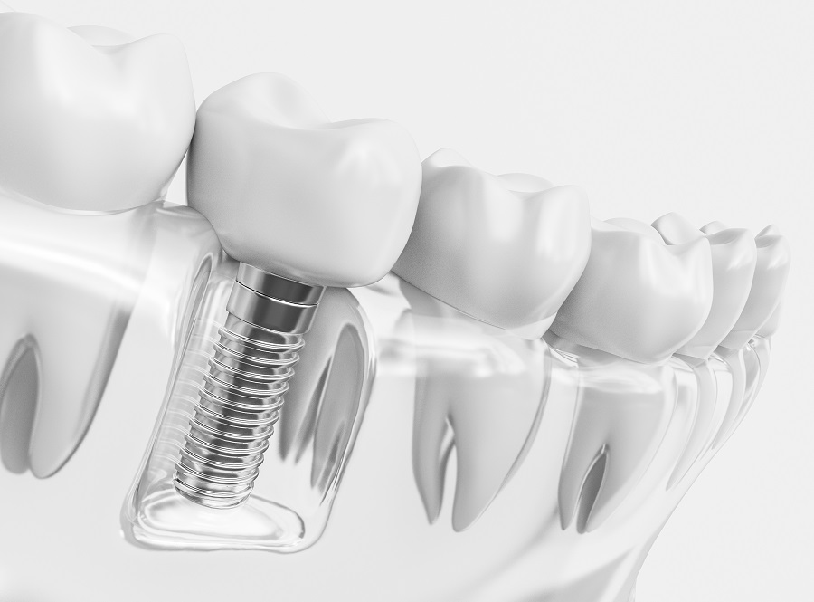 Dental Implant Surgery in San Jose