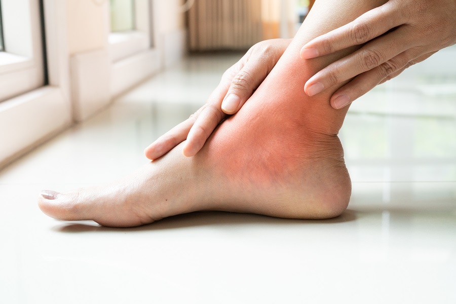 What Is Gouty Arthritis? – Treatment for Gouty Arthritis