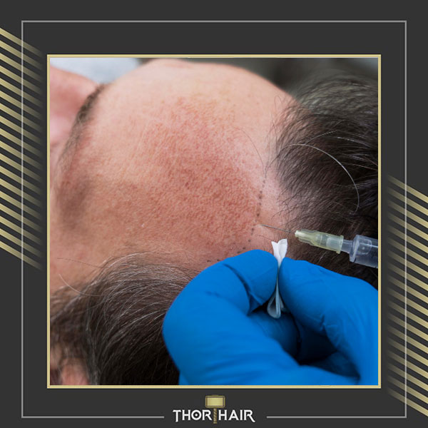 Why is Turkey so popular for hair transplant?