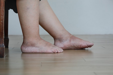 Diabetic foot problems