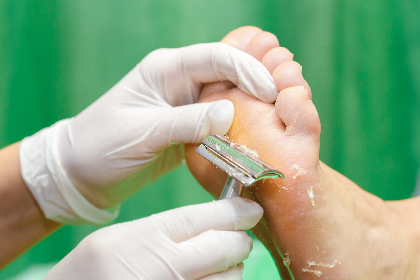 Callus Removal At Home: 5 Top Tips - Northwich Foot Clinic