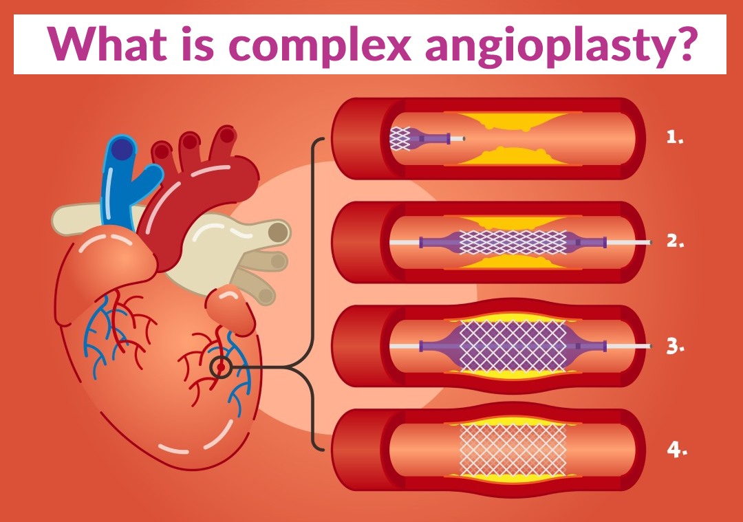 angioplasty