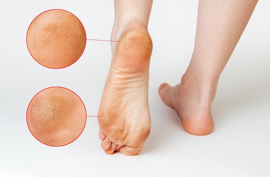 Dry, Cracked Heels: Quick Fixes, Remedies, Tools, and More! - Own Harmony