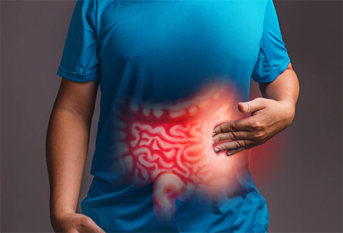 Irritable Bowel Syndrome