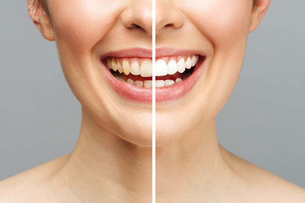 Teeth Whitening in San Jose