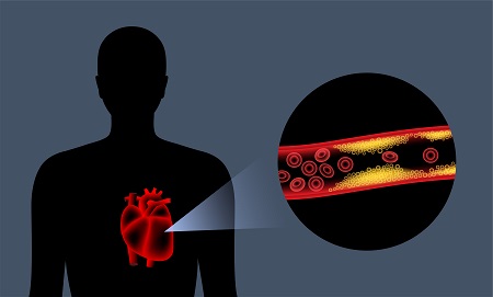 Coronary Artery Disease