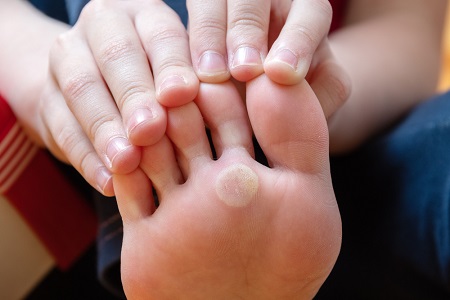 Say Goodbye to Foot Corns and Calluses with Effective Treatment
