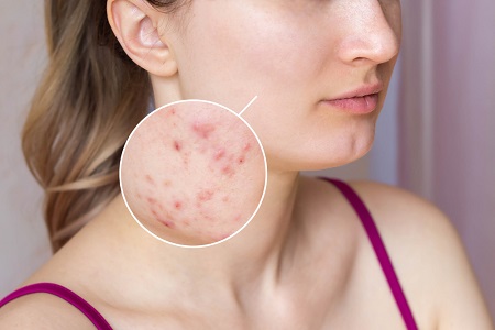 Morpheus8 Treatment for Acne Scars - A Breakthrough Solution