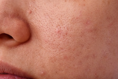 Morpheus8 for Acne Scars