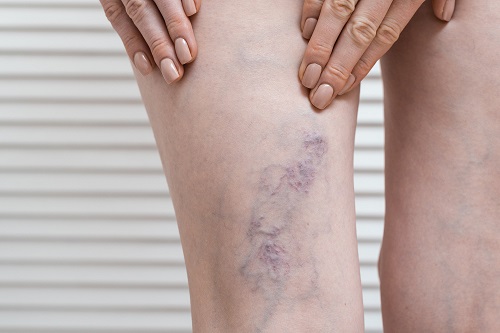 Varicose Veins