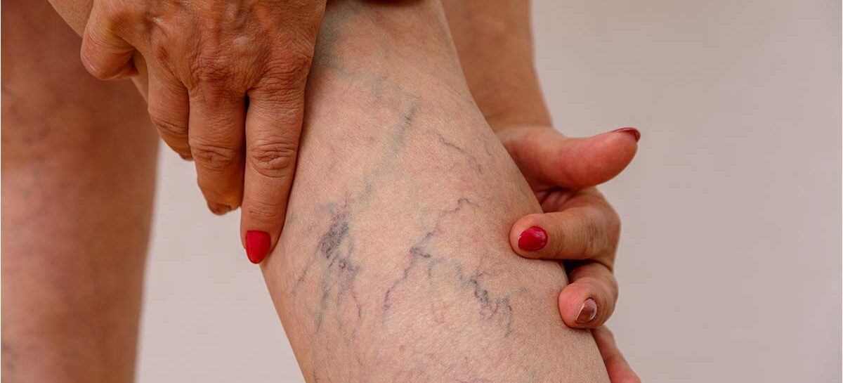 Venous Insufficiency – Symptoms, Diagnosis and Treatment